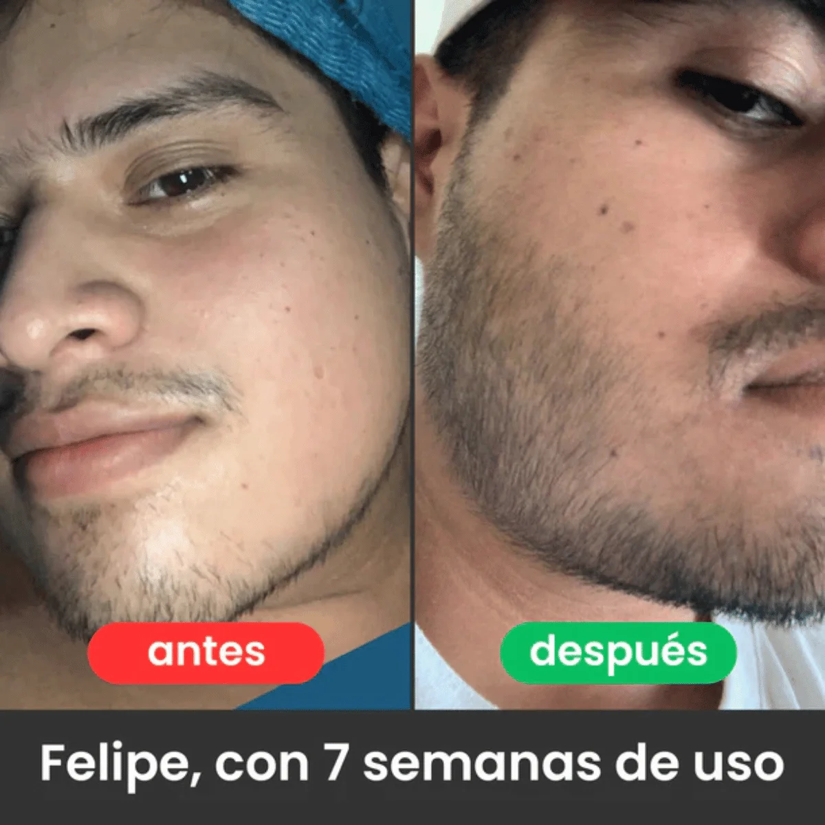 APOLO Ultra-Potent Beard Growth Balm 100 ml (Minoxidil 20%) - Image 4